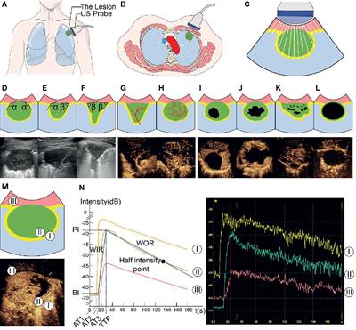 Development and Prospective Validation of an Ultrasound Prediction Model for the Differential Diagnosis of Benign and Malignant Subpleural Pulmonary Lesions: A Large <mark class="highlighted">Ambispective Cohort Study</mark>